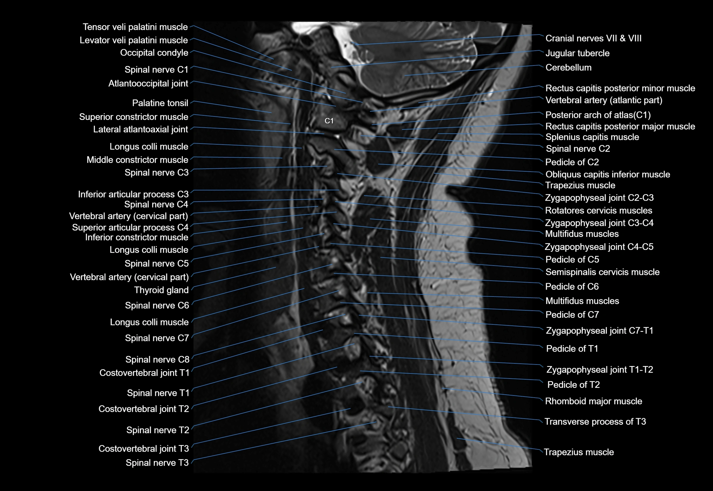 cervical spine cross sectional MRI anatomy 3T MRI  sagittal image-img-00001-00010.webp